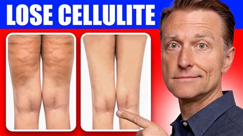 cul cellulite|mild cellulite on legs.